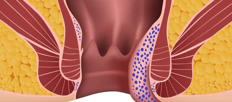 Варикоз Вен Заднего Прохода