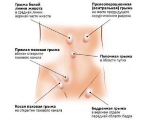 Паховая грыжа справа у девочки 5 лет