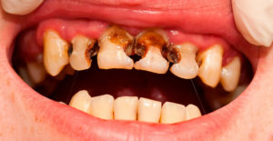 Пеньки передних зубов