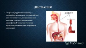 Непроходимость пищи и воды при глотании у пожилой женщины