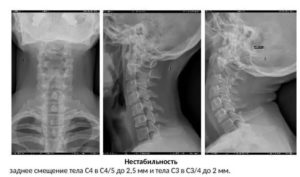 Функциональная флюорография шейного отдела позвоночника