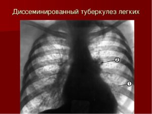 Очаговые поражения легких