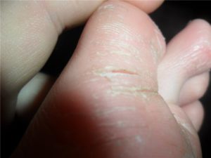 Нескончаемый зуд на пальцах ног. Шелушится и трескается кожа