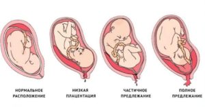 Низкое расположение матки при беременности