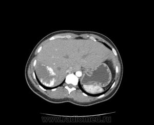 Гемангиома правой почки МРТ или КТ?