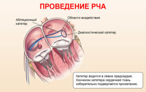 Одышка после рча (абляции) сердца