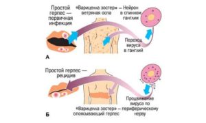 Герпес 2 подтип Частый рецидив. 1 раз в месяц минимум