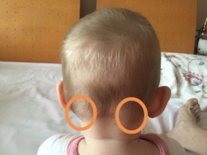 Несколько шишек на голове у ребенка