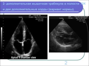 Ооо 1.6 мм и дополнительная хорда в полости левого желудочка