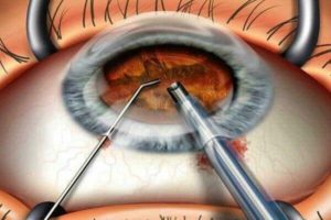 Гноится глаз после удаления катаракты