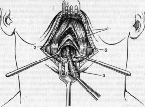 Операция срединная киста шеи
