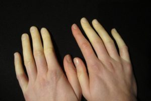 Нервный тик пальцев правой руки