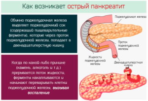 Панкреатит или нет его?