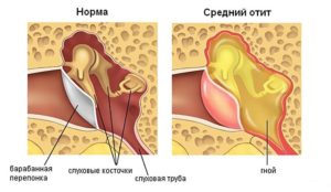 Острый посттравматический средний отит