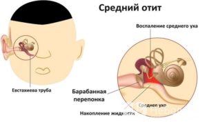 Отит при беременности