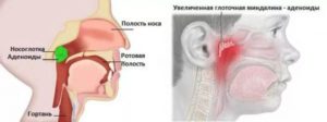 Гипертрофия аденоидов 1-2 степени, гипертрофия миндалин 2-3 ст