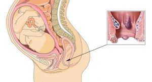 Геморрой при беременности 24-25 недель