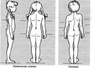 Одна нога короче другой на 0,5 см