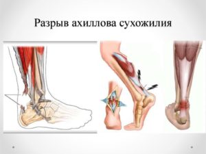 Операция голеностопа пластика по Чернавскому Полный разрыв связок пяточного сухожилия