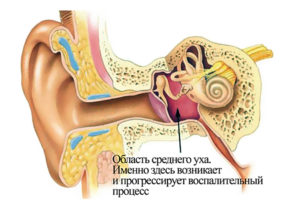 Не проходит средний отит