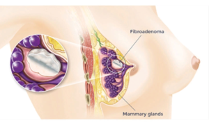 Фиброаденома левой груди