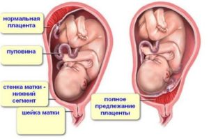 Низкая плацентация, ан. Тяж, беременность 31 неделя