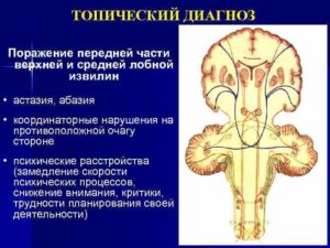 Органическое поражение ЦНС, астазия-абазия