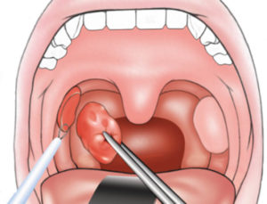 Опухоль ниже миндалины
