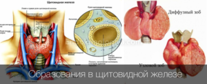 Очаговые диффузные изменения в щитовидной железе