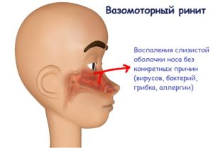 Ощущения распирания в переносице, вазомоторный ринит