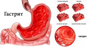 Неприятный привкус при гастрите и реакция на лекарства