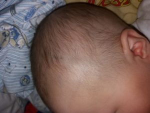 Несколько шишек на голове у ребенка