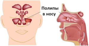 Отек в носу после удаления аденоидов