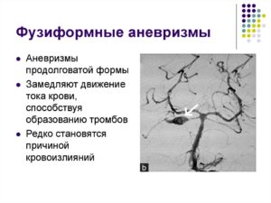 Фузиформная аневризма