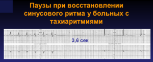 Паузы в сердечном ритме у ребенка