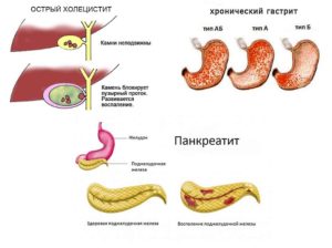 Панкреатит, холецистит, гастрит