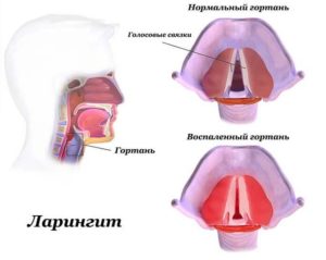 Печёт и отекает гортань