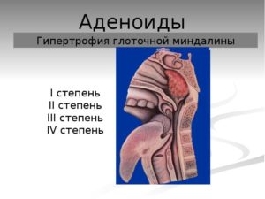 Гипертрофия аденоидов 1-2 степени, гипертрофия миндалин 2-3 ст