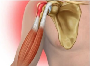Отрыв длинной головки двуглавой мышцы плеча и ее сухожилие