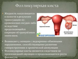 Фолликулярная киста и лечение