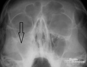 Острый синусит, ухудшения по рентгену