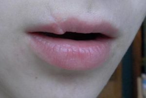 Опухла внутренняя половая губа с внешней стороны