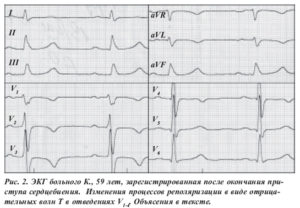 Неспецифические изменения фазы реполяризации на ЭКГ для мвд