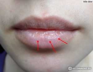 Грубые корочки на нижней губе