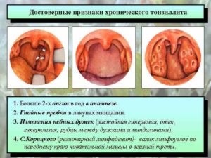 Гиперплазия или хронический тонзиллит?