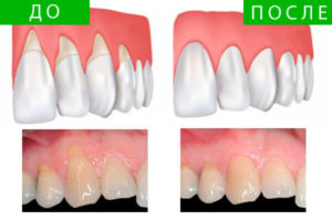Отходят десны от зубов