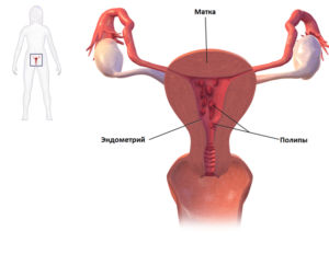 Фитотерапия при полипе эндометрия и миоме