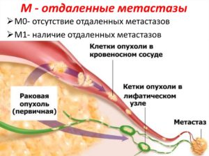 Онкология, рецедив, гиперактивное распространение опухоли