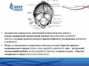 Определяется некоторая продавленность борозды поперечного синуса