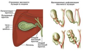 Перегиб желчного пузыря, гомогенная полость